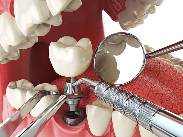 Best Emergency Dentist for Knocked-Out Tooth in Llender, CA